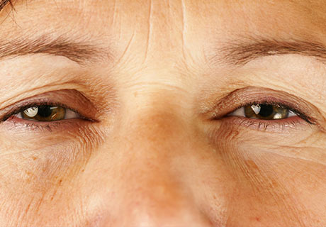 blefaroplastia