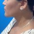 Liposucción papada mujeres despues | | Cirugía Plástica | Dr. Samano | Cirujano Plastico Cancún