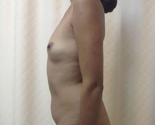 Before-Aumento de Busto