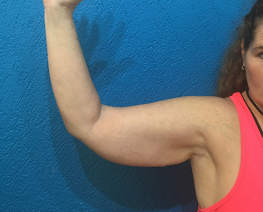 Before-Braquiplastia