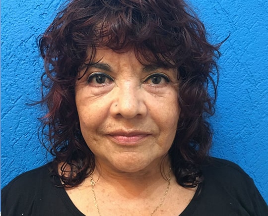 After-Bleferoplastia