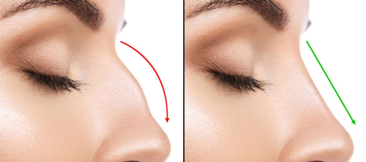 Rinoplastia en Cancun armoniza tu rostro con resultados naturales